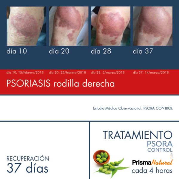 Psora Control Dermactiv 100 ml - PRISMA NATURAL Img 4