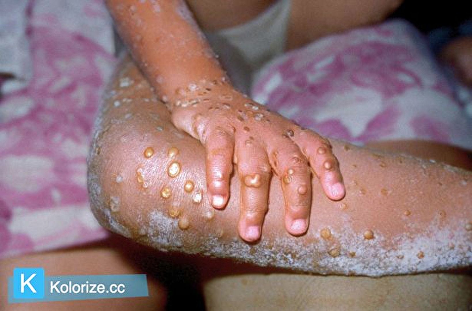 África declara la emergencia sanitaria por la viruela del mono en todo el continente. Mpox (monkeypox)